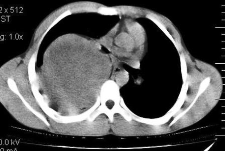 Figure 2: CECT thorax showing involvement of pleura and pleural reaction